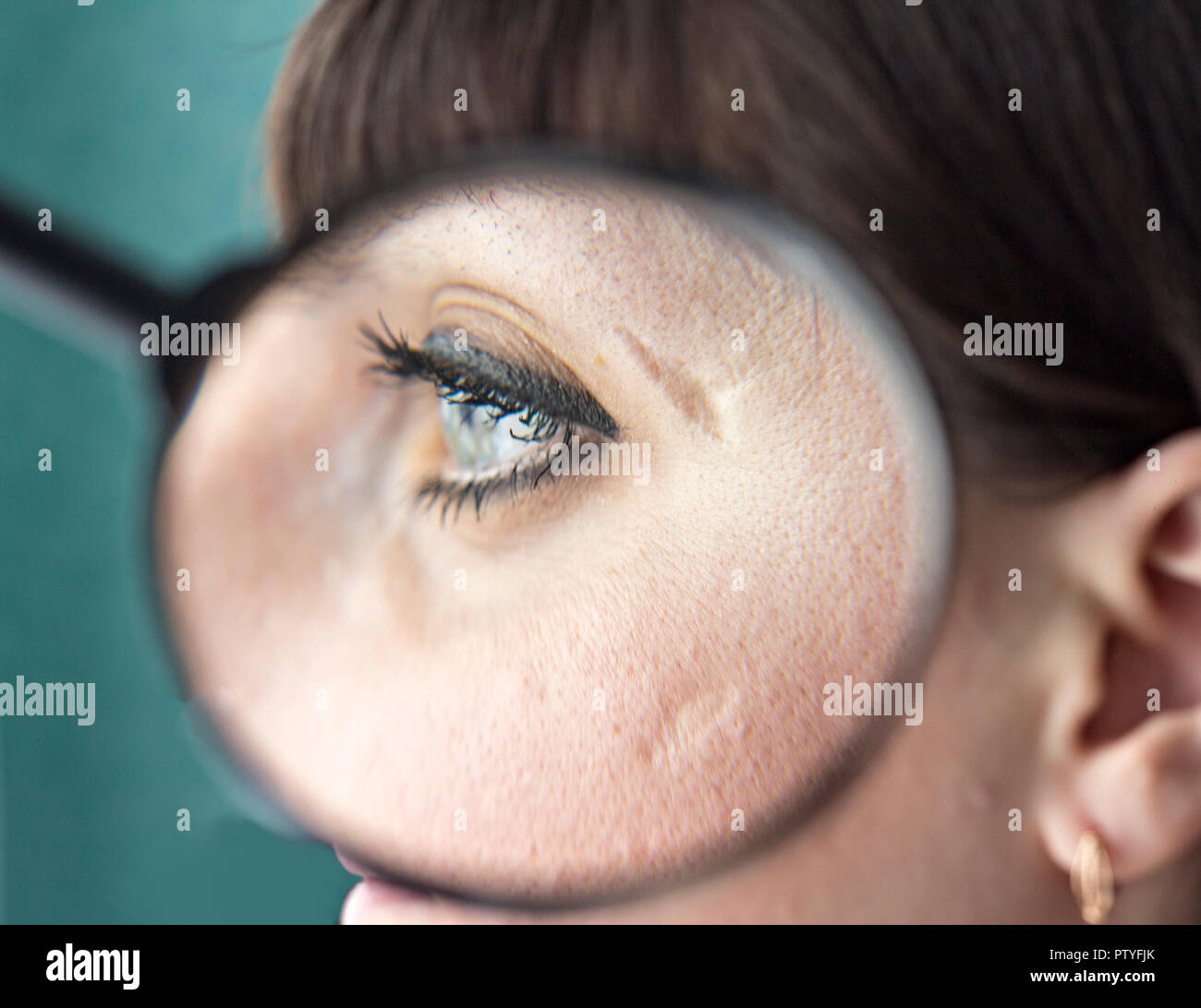 Narben auf dem Gesicht eines Mädchens, das durch ein Vergrößerungsglas, close-up Stockfoto