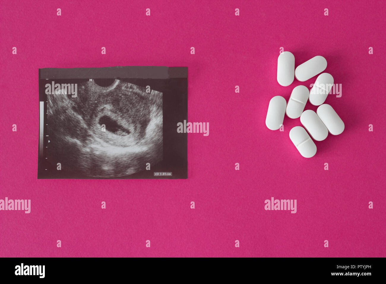 Uzi der Schwangerschaft auf einem rosa Hintergrund und Pillen, die Abtreibung. Stockfoto