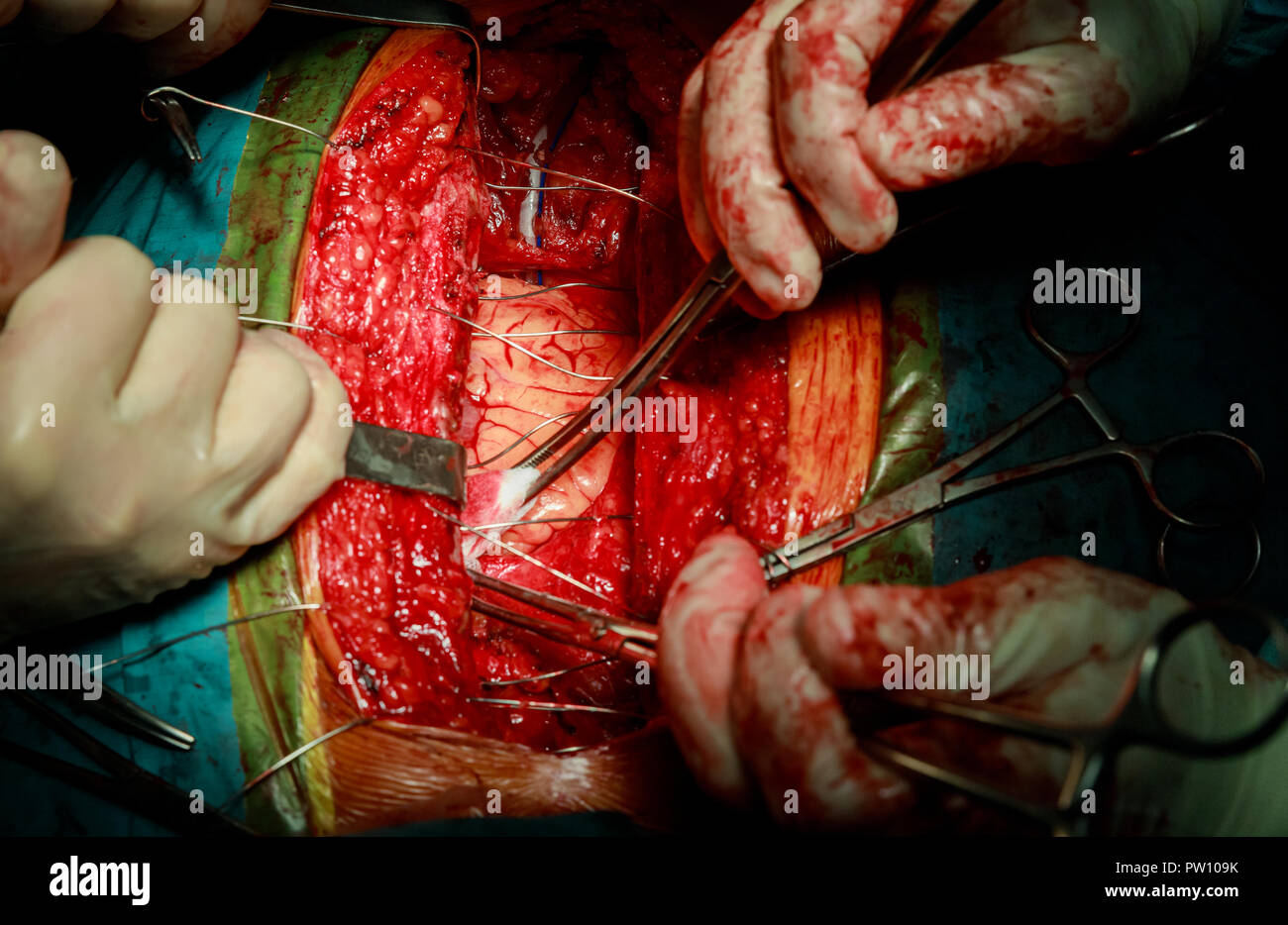 Der Chirurg Hände Steppnaht die Gewebe des Kopfes nach dem Kernbohren Stockfoto
