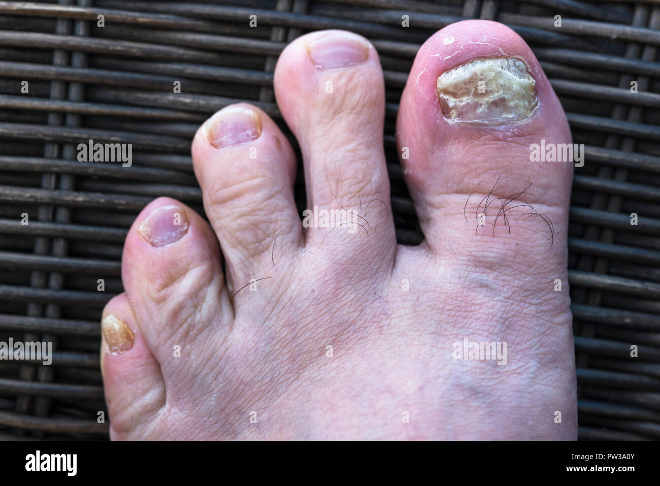 Pilzartige Nagelinfektion auf männliche Zehe. Stockfoto