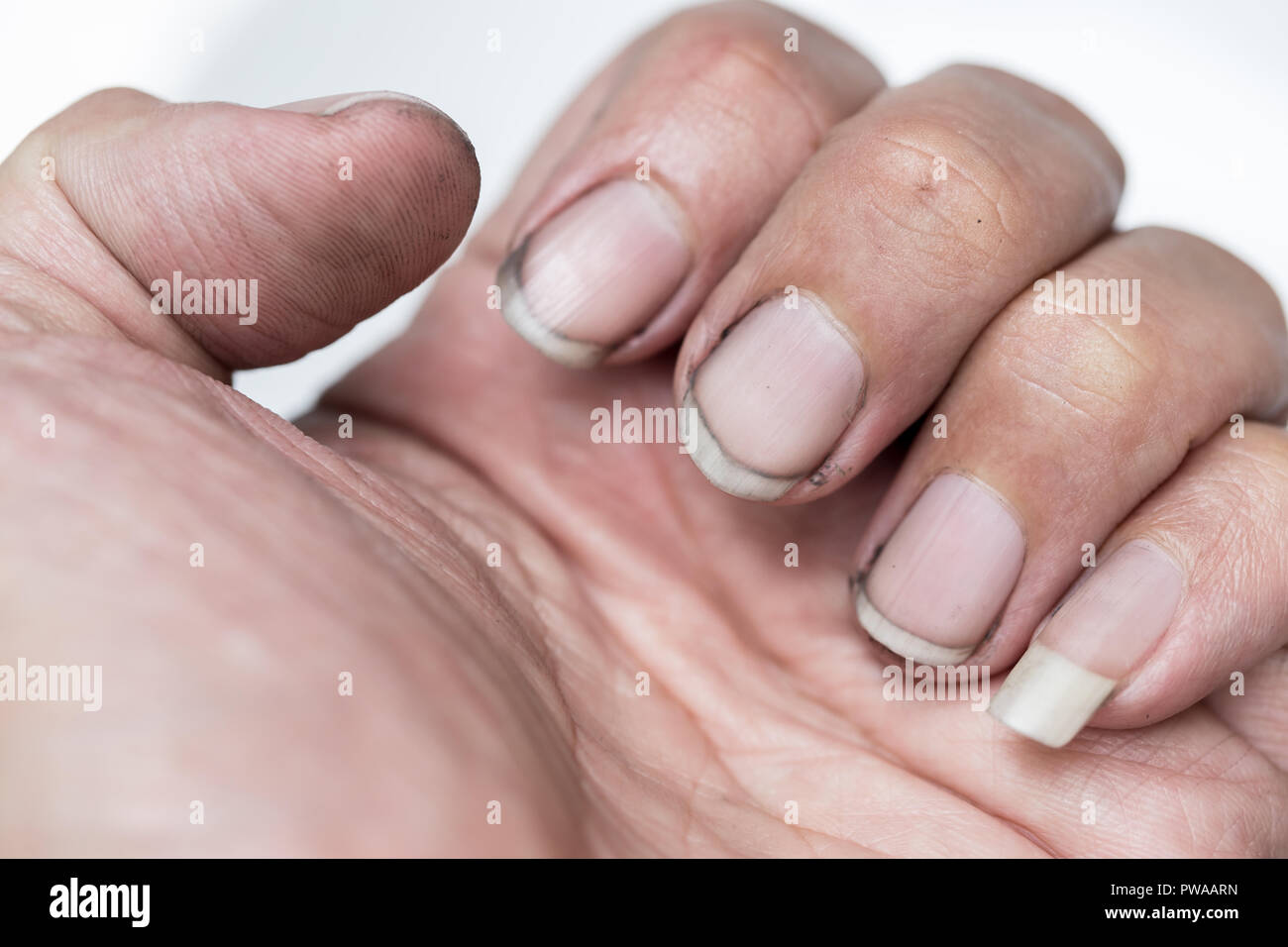 Nagelpilz Finger Fotos Und Bildmaterial In Hoher Aufl sung Alamy