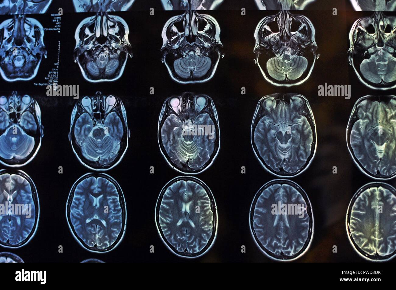 Magnetic Resonance Image Scan des Gehirns. Mrt-Film von einem menschlichen Schädel und Gehirn. Neurologie Hintergrund. Medizin, Wissenschaft, Vorderansicht Stockfoto