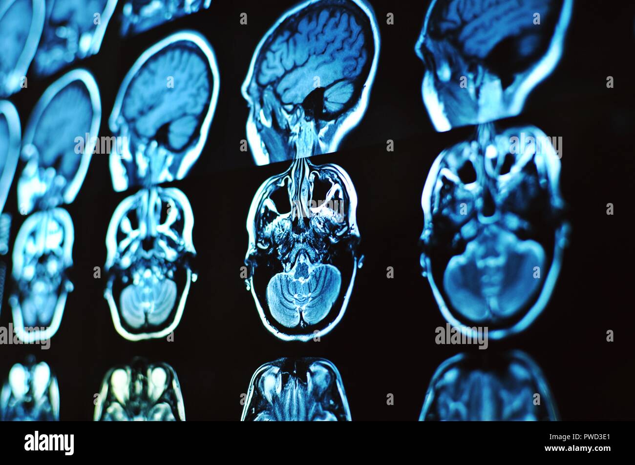 Magnetic Resonance Image Scan des Gehirns. Mrt-Film von einem menschlichen Schädel und Gehirn. Neurologie Hintergrund. Medizin, Wissenschaft, Seitenansicht Stockfoto