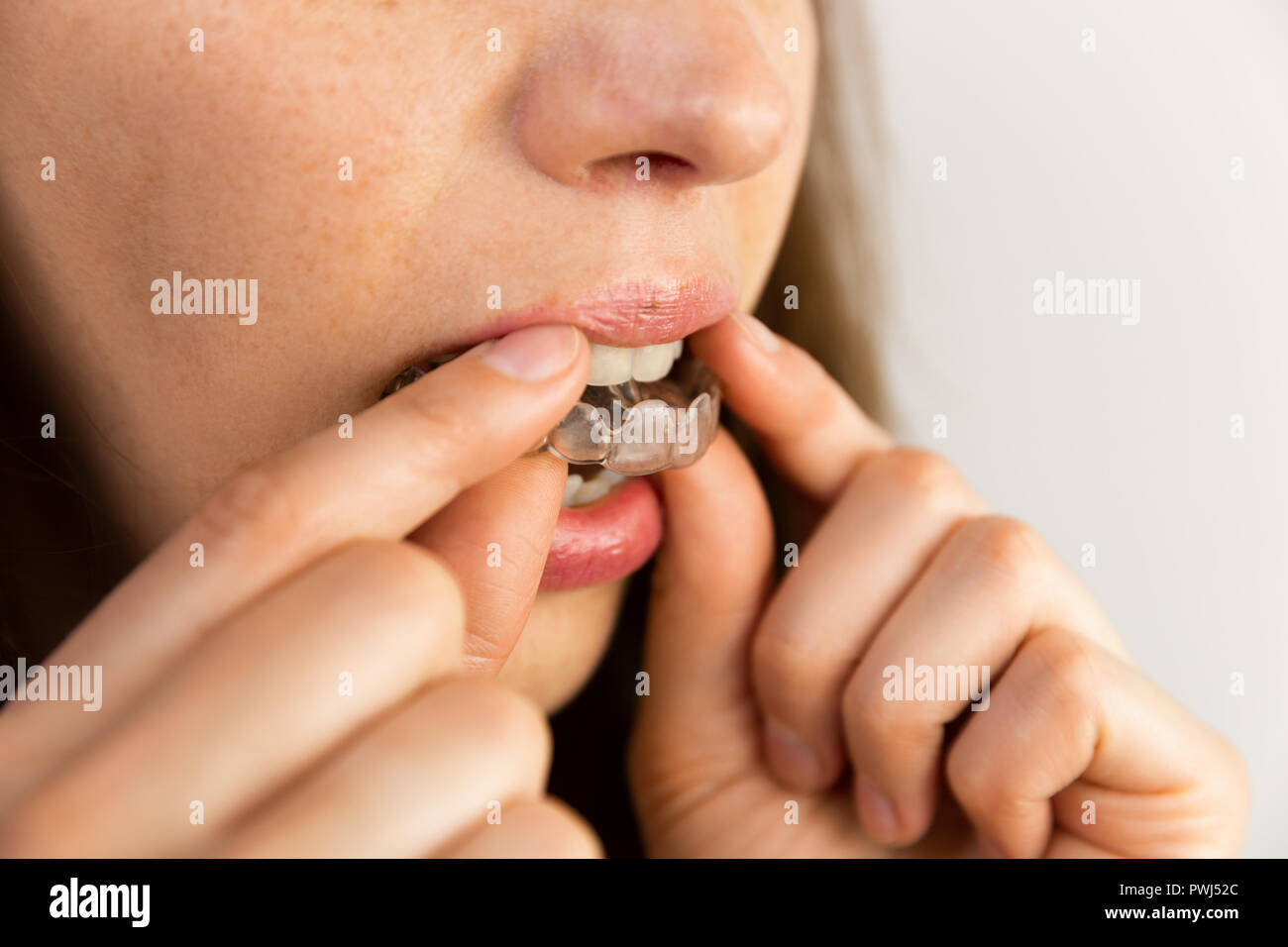 Junge Frau setzt transparente Ausrichter für zahnmedizinische Behandlung Stockfoto
