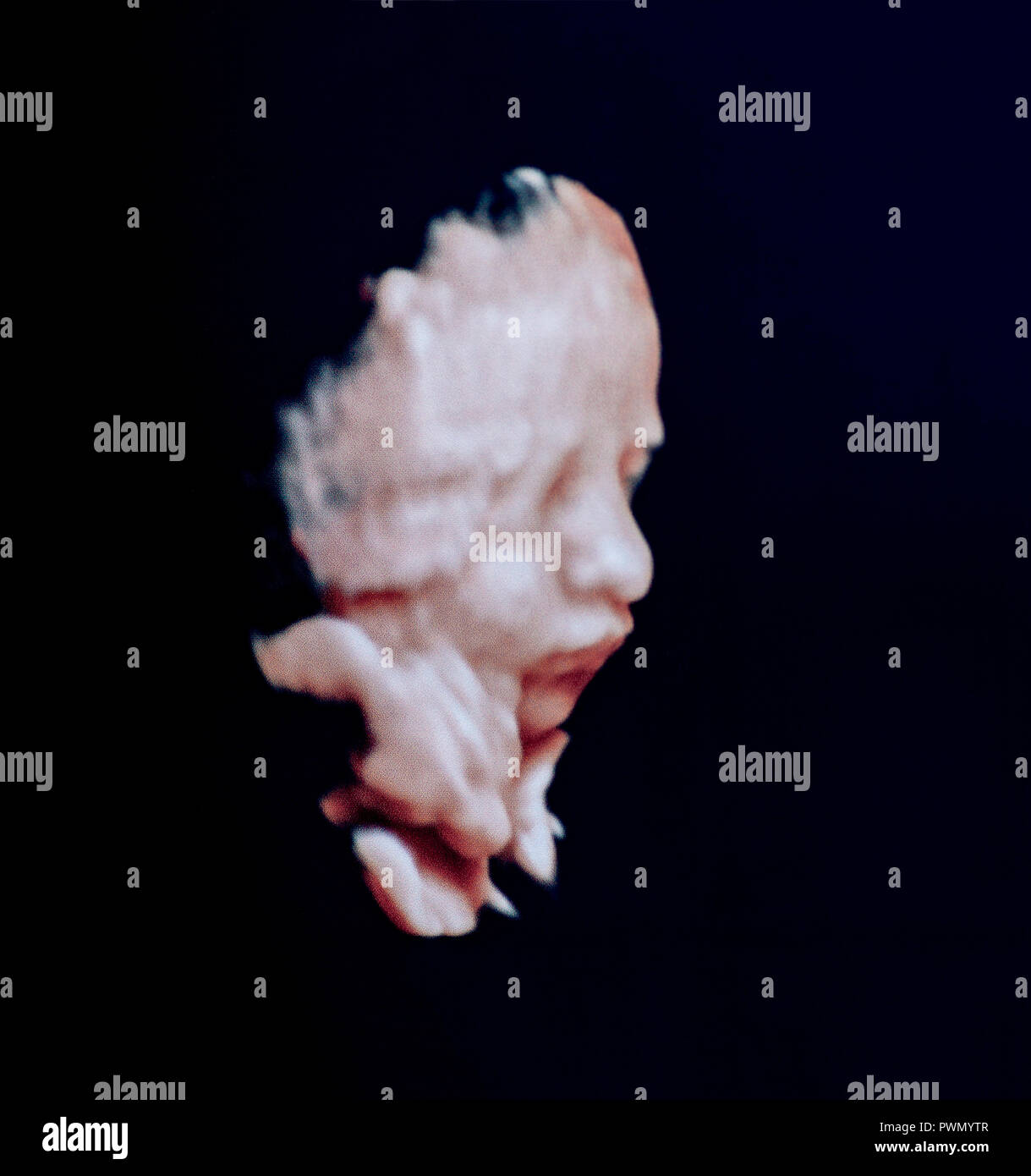 Ultraschall Porträt eines Fötus im Mutterleib, mit sichtbaren pixelation und Farbrauschen einer digitalen Drucken. Stockfoto