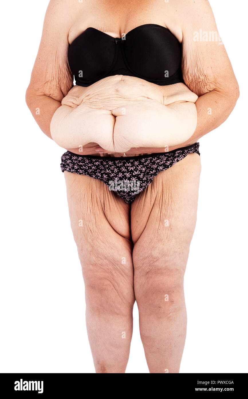 Frauen mittleren Alters mit schlaffe Haut nach extremen Gewichtsverlust Stockfoto