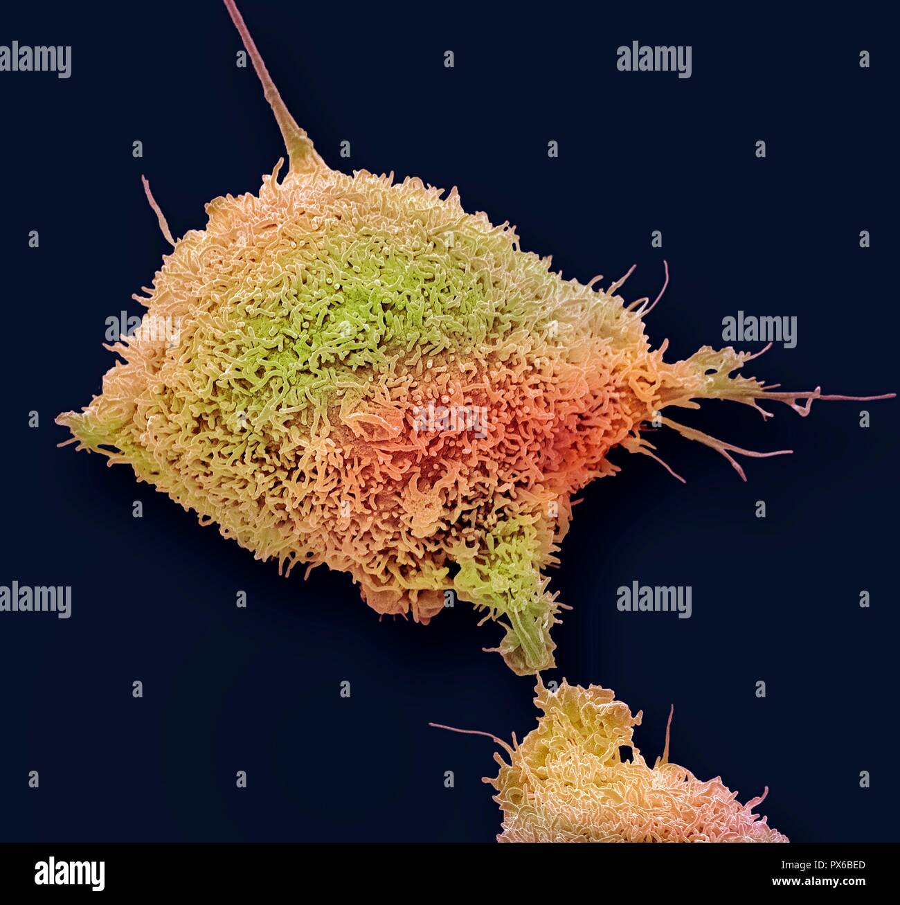 Gebärmutterhalskrebs Zelle. Farbige Scanning Electron Micrograph (SEM) eine kultivierte Krebszellen (HeLa) von einem menschlichen Cervix, zeigen die zahlreichen Mikrovilli (Haar - wie Strukturen) Eigenschaft von Krebszellen. HeLa Zellen sind ein kontinuierlich kultivierten Zellen des Unsterblichen menschlichen Krebszellen. Wie Sie sind unsterblich, sie im Labor wachsen und sind weit verbreitet in der biologischen und medizinischen Forschung eingesetzt. Krebs des Gebärmutterhalses (der Hals der Gebärmutter) ist eine der häufigsten Krebserkrankungen bei Frauen. Vergrößerung: x6000, wenn 10 Zentimeter Breite gedruckt. Stockfoto