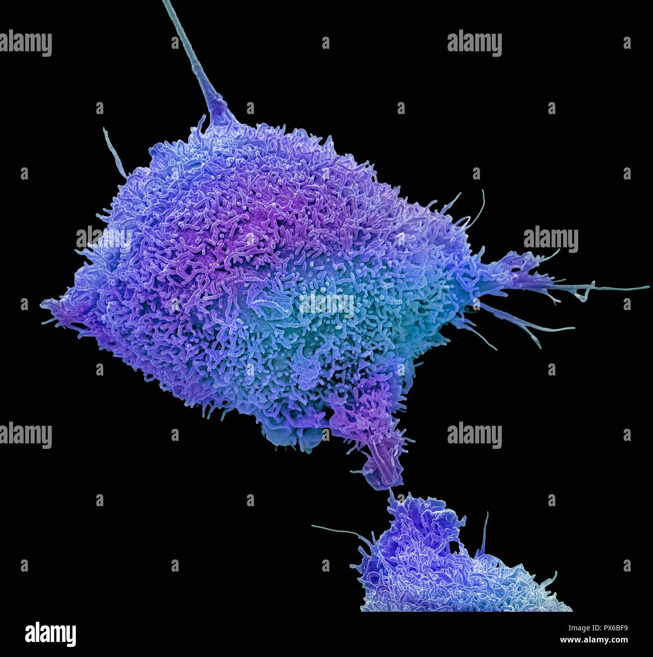 Gebärmutterhalskrebs Zelle. Farbige Scanning Electron Micrograph (SEM) eine kultivierte Krebszellen (HeLa) von einem menschlichen Cervix, zeigen die zahlreichen Mikrovilli (Haar - wie Strukturen) Eigenschaft von Krebszellen. HeLa Zellen sind ein kontinuierlich kultivierten Zellen des Unsterblichen menschlichen Krebszellen. Wie Sie sind unsterblich, sie im Labor wachsen und sind weit verbreitet in der biologischen und medizinischen Forschung eingesetzt. Krebs des Gebärmutterhalses (der Hals der Gebärmutter) ist eine der häufigsten Krebserkrankungen bei Frauen. Vergrößerung: x6000, wenn 10 Zentimeter Breite gedruckt. Stockfoto