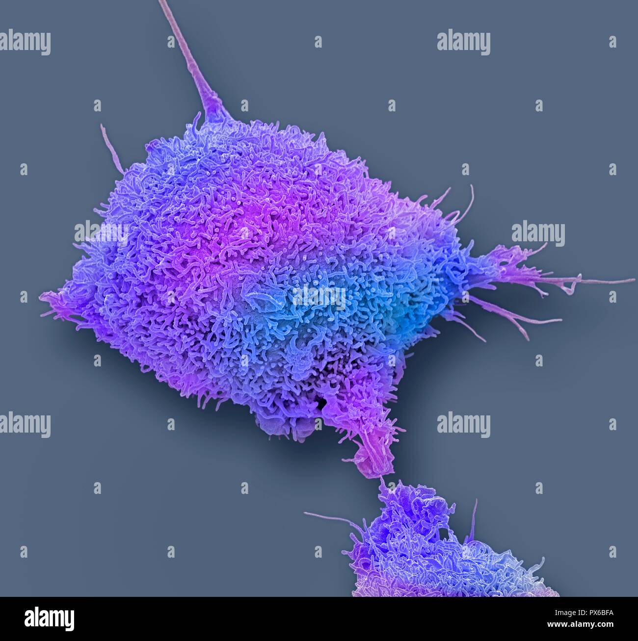 Gebärmutterhalskrebs Zelle. Farbige Scanning Electron Micrograph (SEM) eine kultivierte Krebszellen (HeLa) von einem menschlichen Cervix, zeigen die zahlreichen Mikrovilli (Haar - wie Strukturen) Eigenschaft von Krebszellen. HeLa Zellen sind ein kontinuierlich kultivierten Zellen des Unsterblichen menschlichen Krebszellen. Wie Sie sind unsterblich, sie im Labor wachsen und sind weit verbreitet in der biologischen und medizinischen Forschung eingesetzt. Krebs des Gebärmutterhalses (der Hals der Gebärmutter) ist eine der häufigsten Krebserkrankungen bei Frauen. Vergrößerung: x6000, wenn 10 Zentimeter Breite gedruckt. Stockfoto