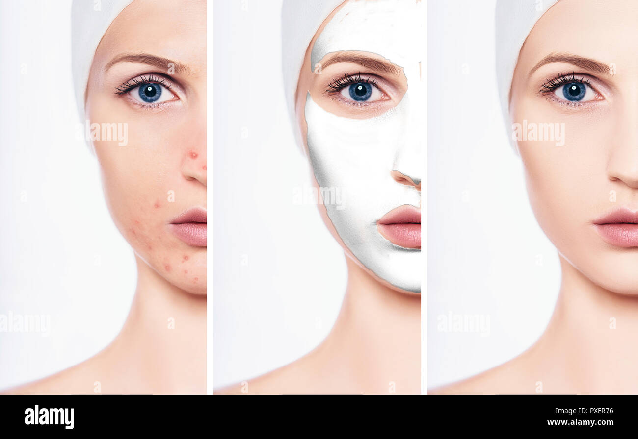 Weibliches Gesicht mit Akne und ohne Akne, nach der Verwendung einer Gesichtsmaske Stockfoto