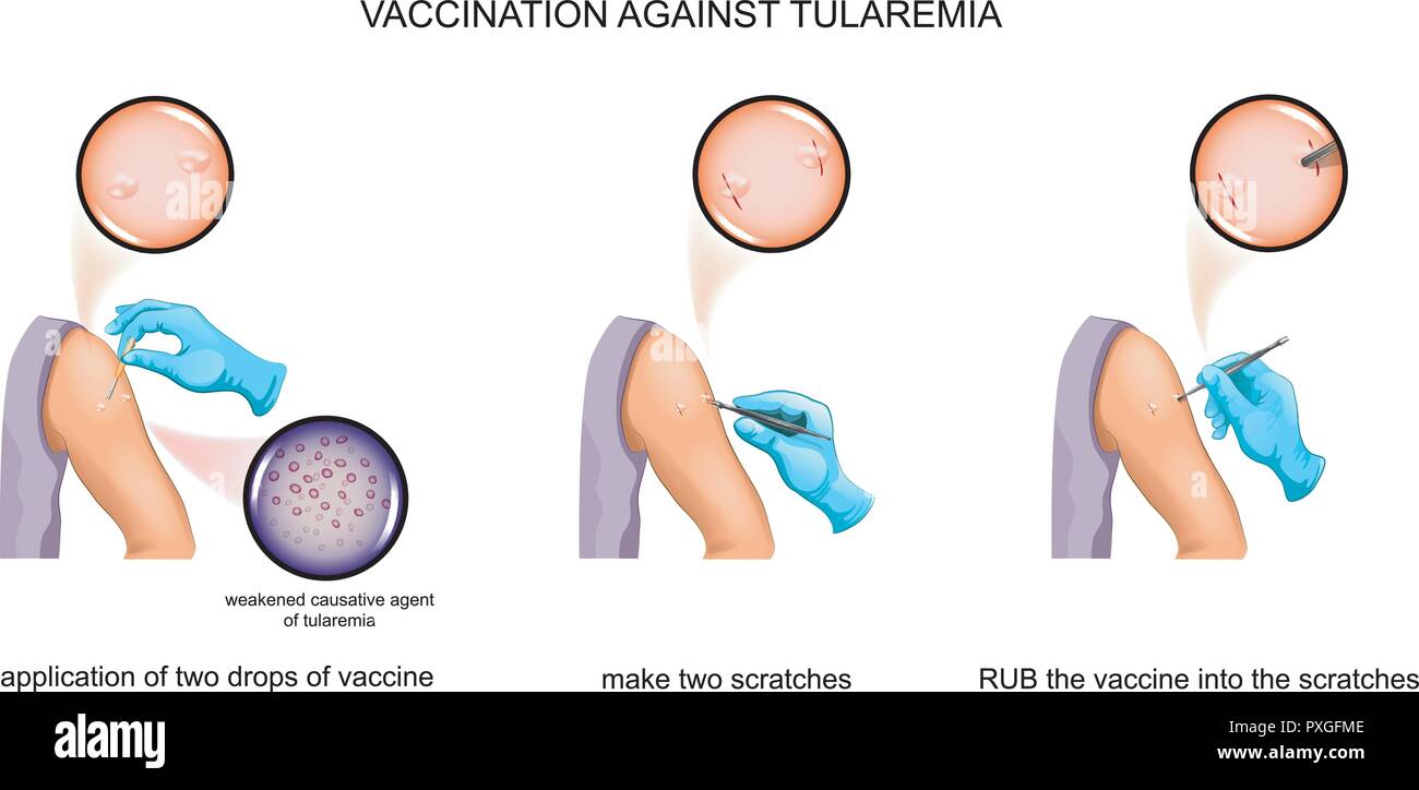 Vector Illustration der Prozess der Impfung gegen die tularämie Stock Vektor