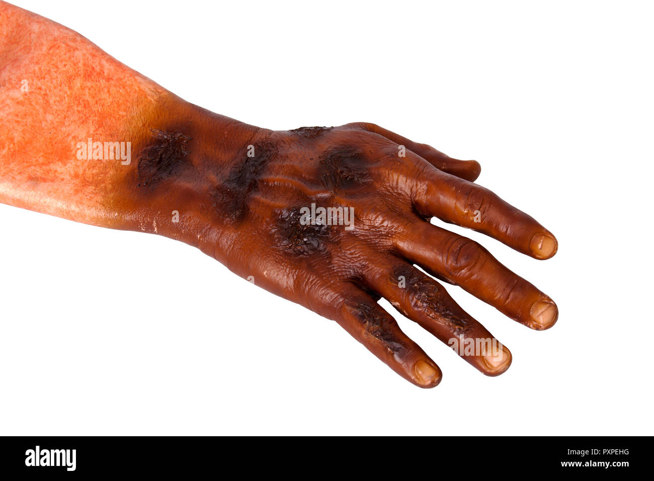 Falsche Hand verbrannt, rettungssanitäter Ausbildung Prop Stockfoto
