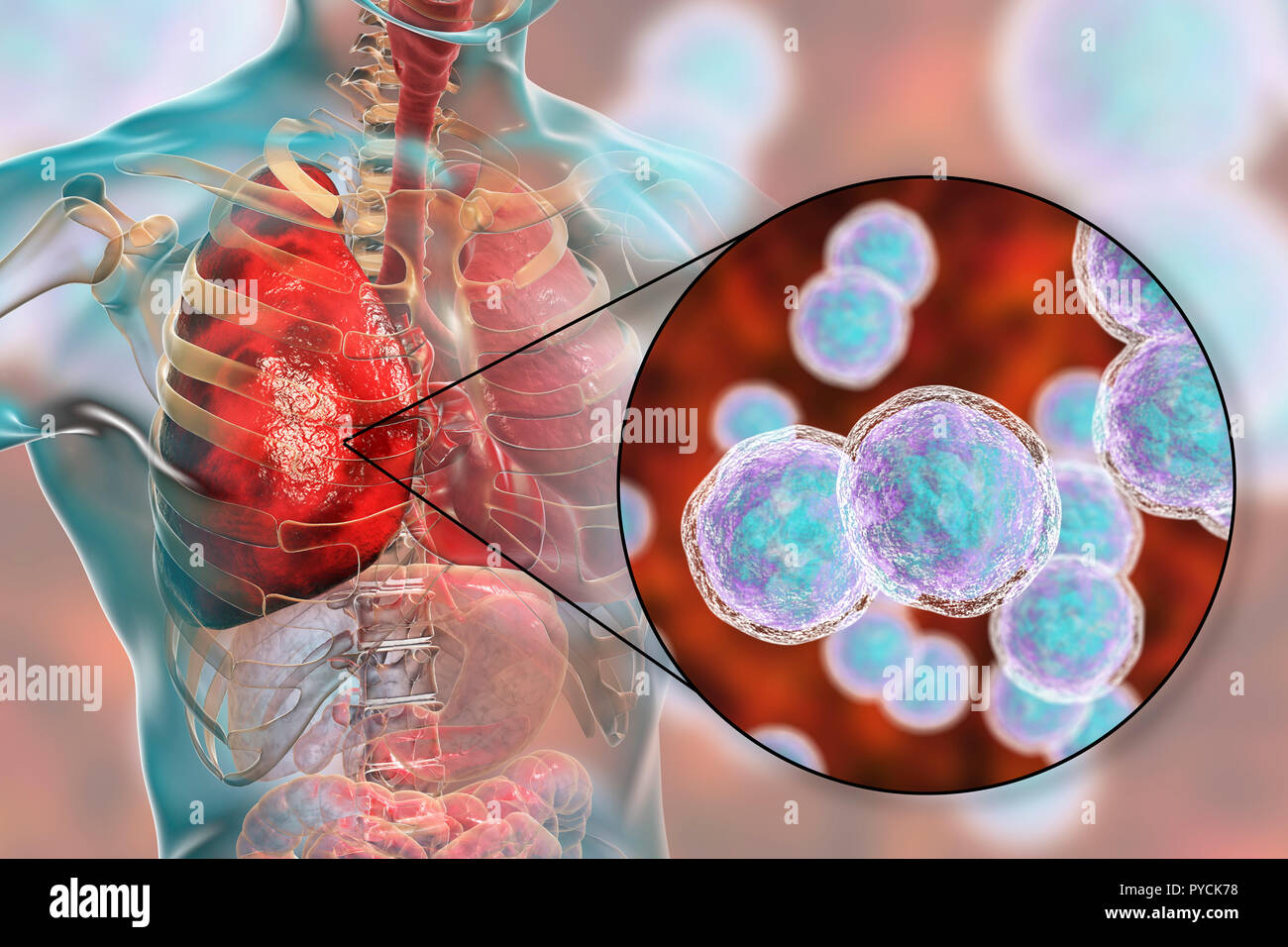 Lungenentzündung verursacht durch Bakterien Moraxella catarrhalis, computer Abbildung. Moraxella (branhamella) Catarrhalis sind aerobe, Gram-negative Kokken (kugelförmige Bakterien). Sie sind in der Regel in den Schleimhäuten der Atemwege der Säugetiere einschließlich des Menschen gefunden. Bei immunsupprimierten Personen, oder opportunistisch, Atemwege, Infektionen, einschließlich Lungenentzündung verursachen. Stockfoto