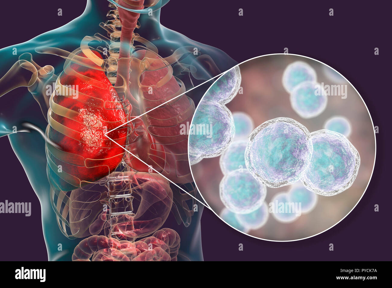 Lungenentzündung verursacht durch Bakterien Moraxella catarrhalis, computer Abbildung. Moraxella (branhamella) Catarrhalis sind aerobe, Gram-negative Kokken (kugelförmige Bakterien). Sie sind in der Regel in den Schleimhäuten der Atemwege der Säugetiere einschließlich des Menschen gefunden. Bei immunsupprimierten Personen, oder opportunistisch, Atemwege, Infektionen, einschließlich Lungenentzündung verursachen. Stockfoto