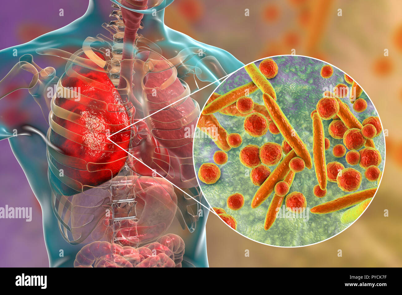 Lungenentzündung durch Mycoplasma pneumoniae Bakterien, konzeptionelle Computer Abbildung verursacht. Mykoplasmen sind die Kleinsten zellulären Organismen bekannt (Durchmesser Stockfoto