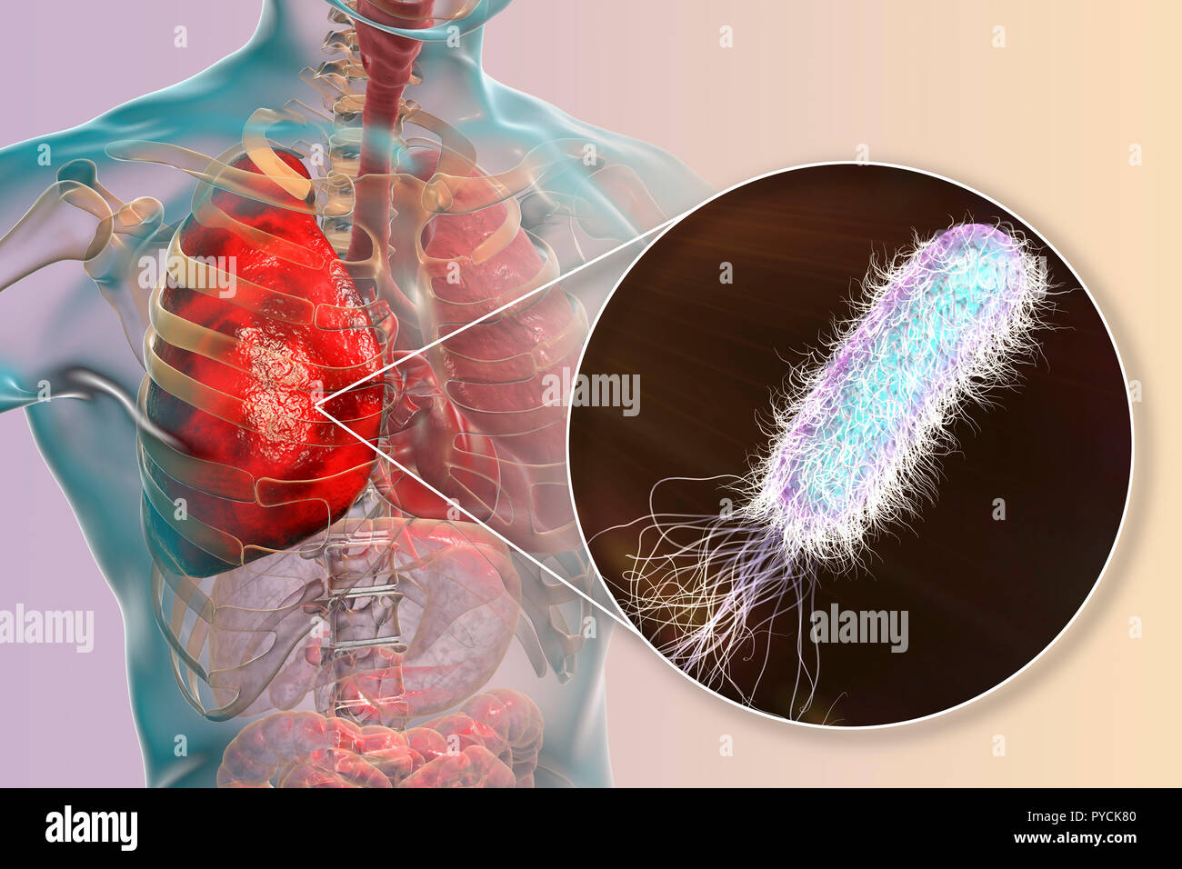 Bakterielle Infektion Im Körper Symptome www.alamy.de