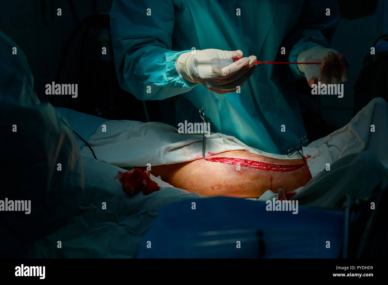 Ein Chirurg aus einer Vene Bein zum Herzen überbrückung Chirurgie Operation im Operationssaal Stockfoto
