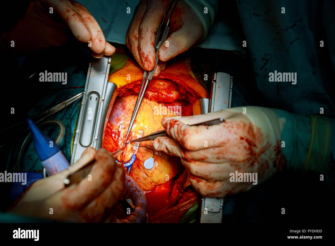 Herzchirurgie. Operation am offenen Herzen naht mehr Saphenous Vein koronarer Bypass-Operation Stockfoto