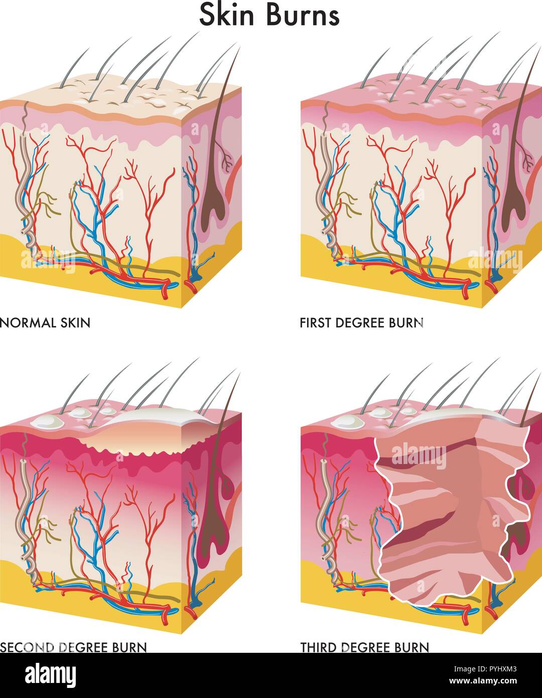 Medizinische Abbildung: die Bildung von Verätzungen der Haut Stock Vektor
