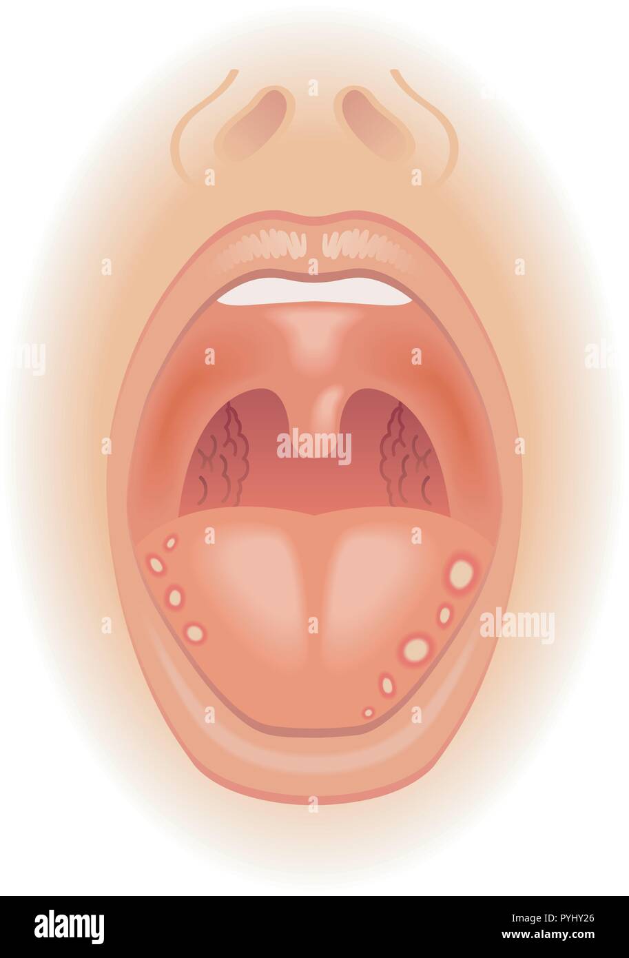 Medizinischen Abbildung von Symptomen der Zunge Wunden Stock Vektor