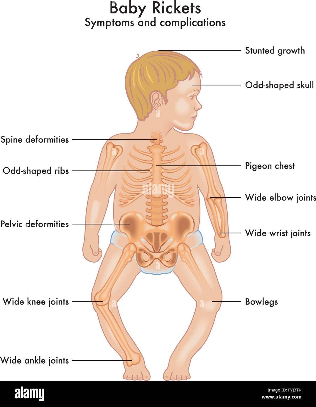 Ein Vektor Abbildung der Anatomie eines Kindes mit rachitis Symptome Stock Vektor