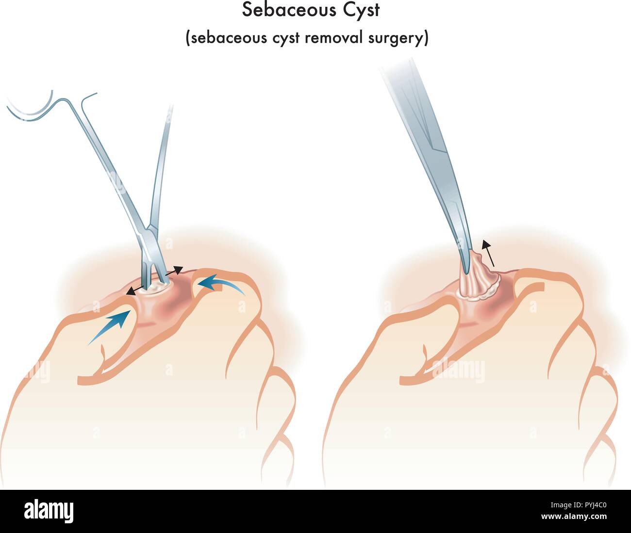 Medizinische Illustration der Talgdrüsen Zyste Entfernung Chirurgie Stock Vektor