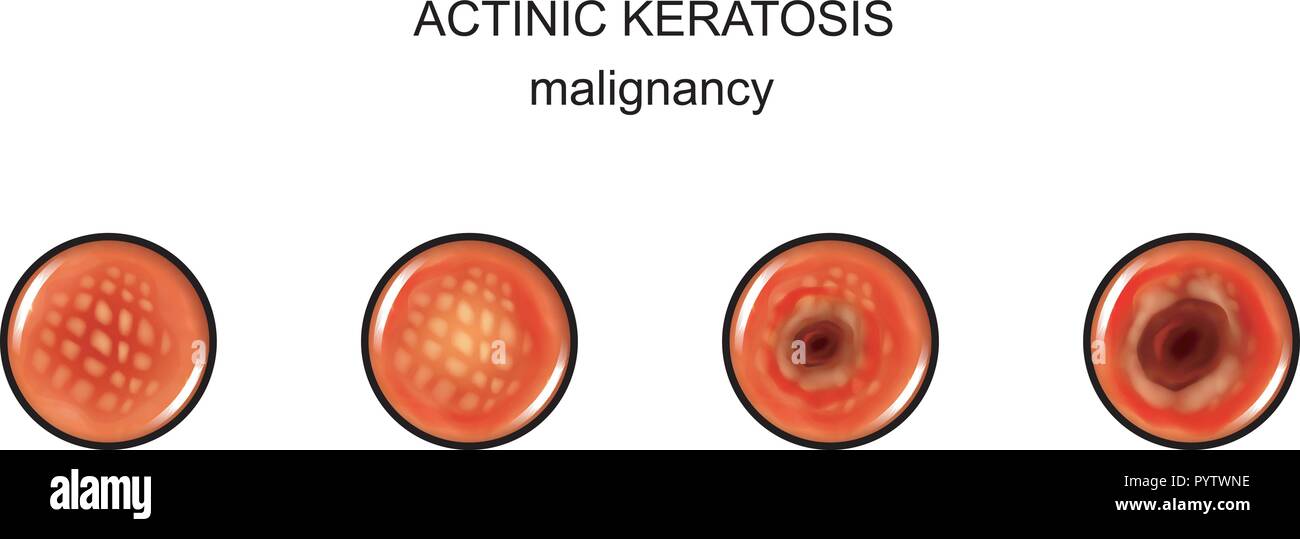 Vector Illustration der aktinischen Keratose. malignization. Krebs Stock Vektor