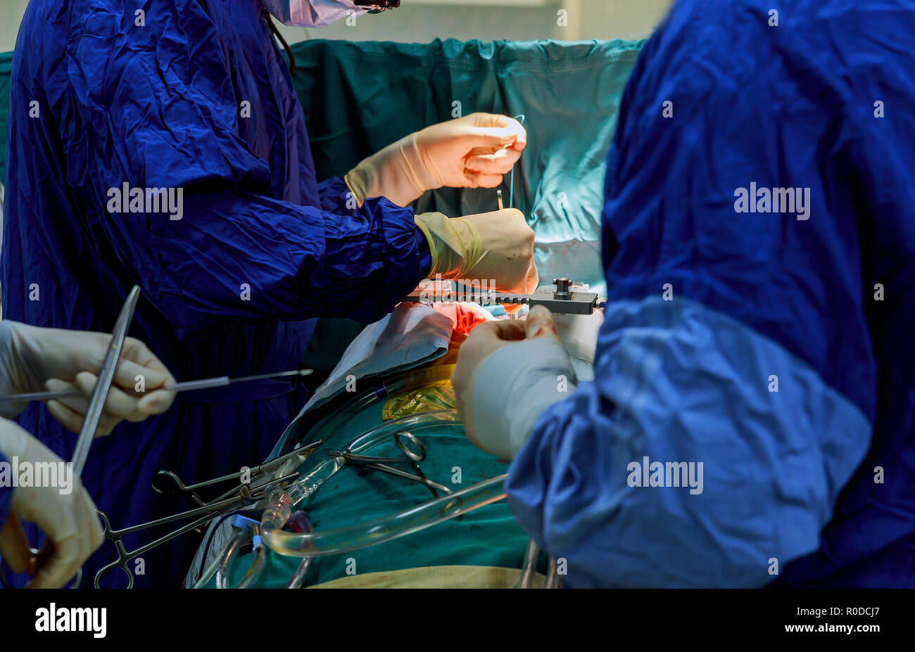 Chirurgen mit chirurgischen Instrument während der Operation am offenen Herzen Stockfoto