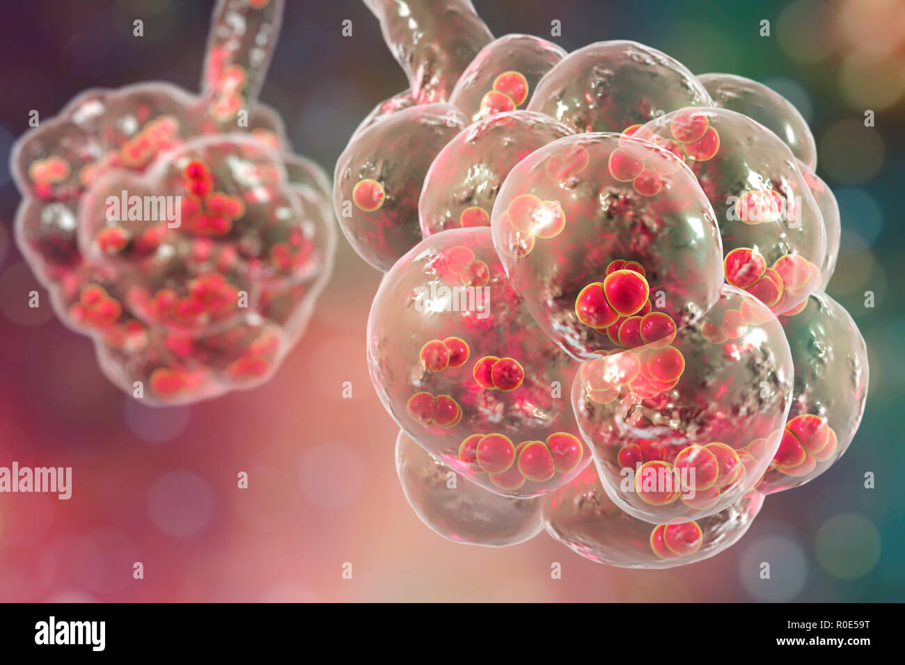 Infecciones pulmonares bacterianas -Fotos und -Bildmaterial in hoher