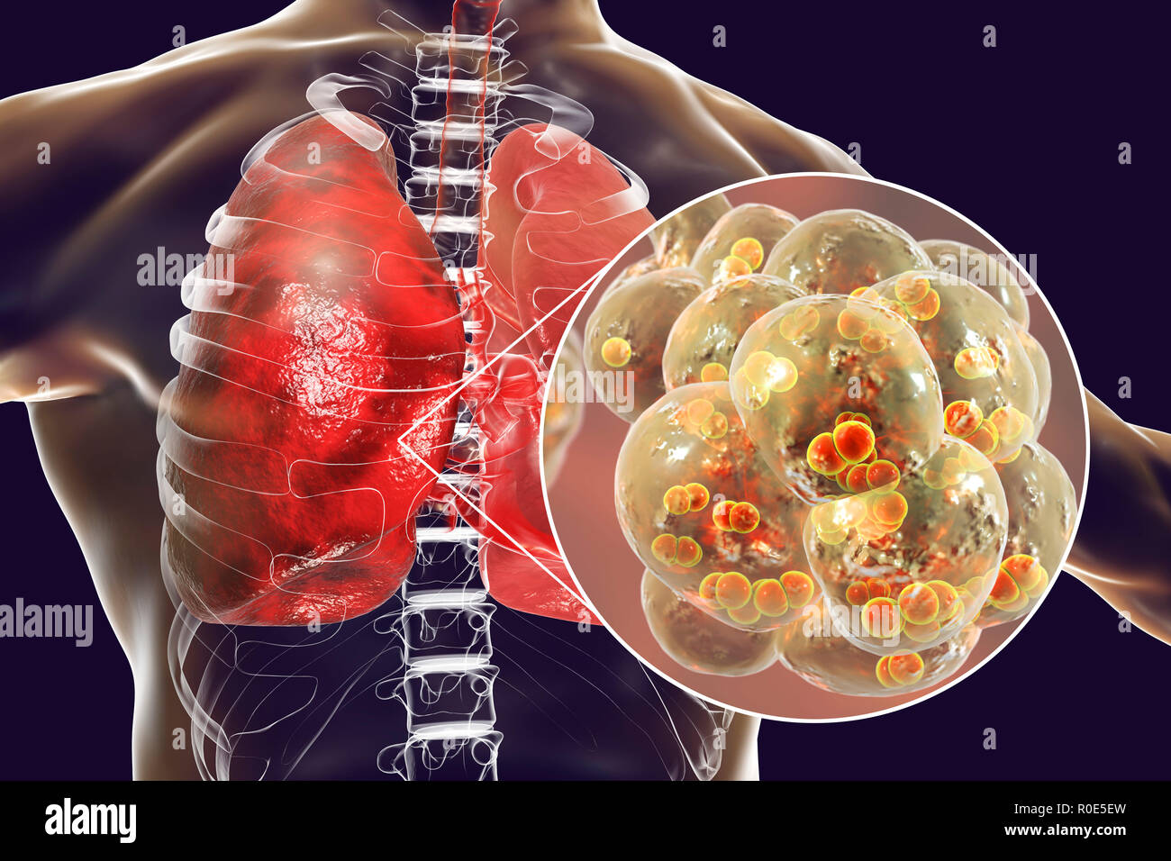 Keim In Der Lunge Ansteckend www.alamy.de