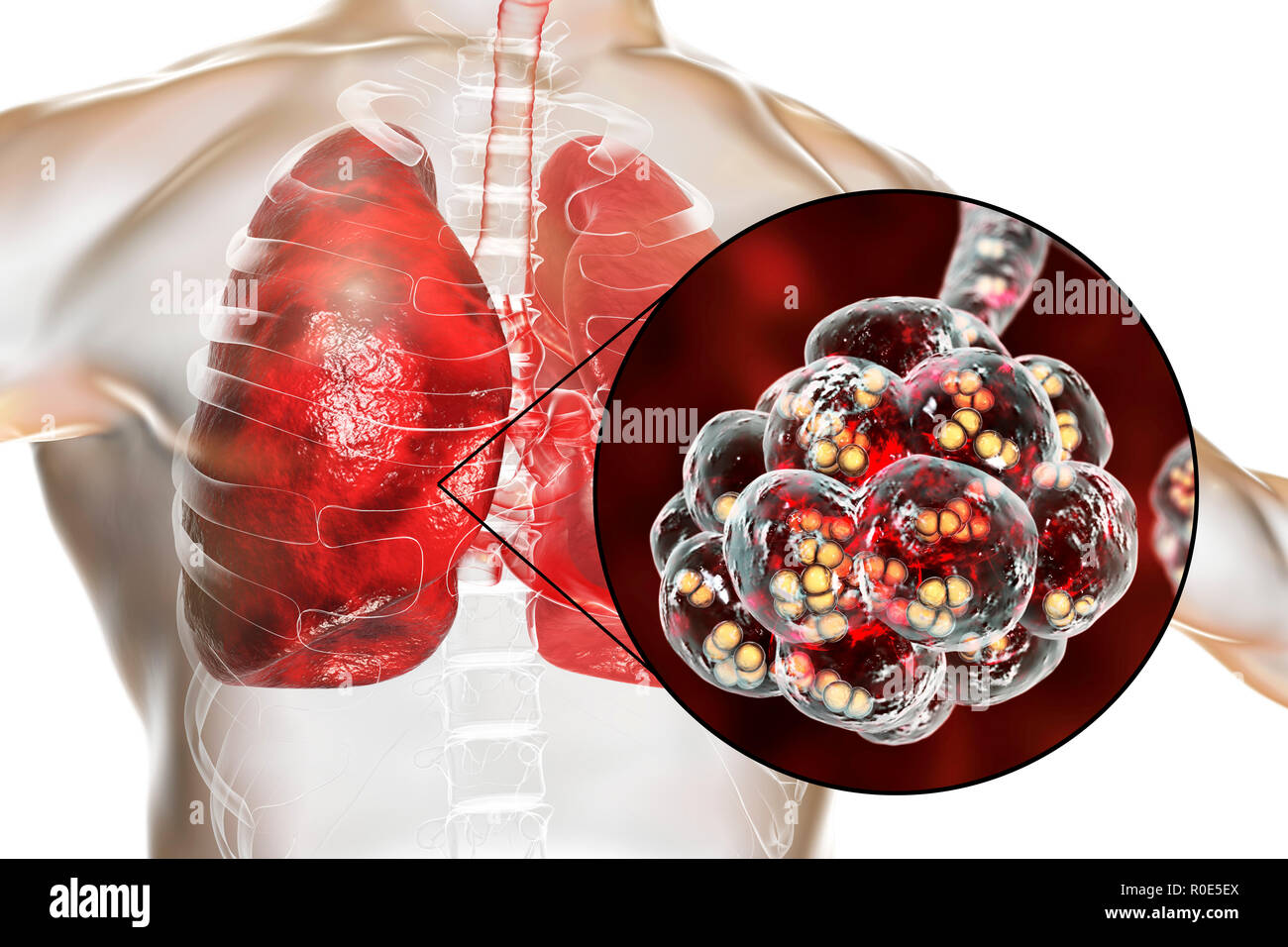 Bakterien In Der Lunge Gefährlich www.alamy.de