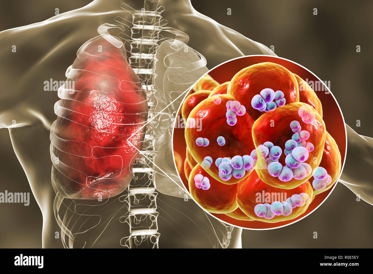 Bakterien In Der Lunge Gefährlich www.alamy.de