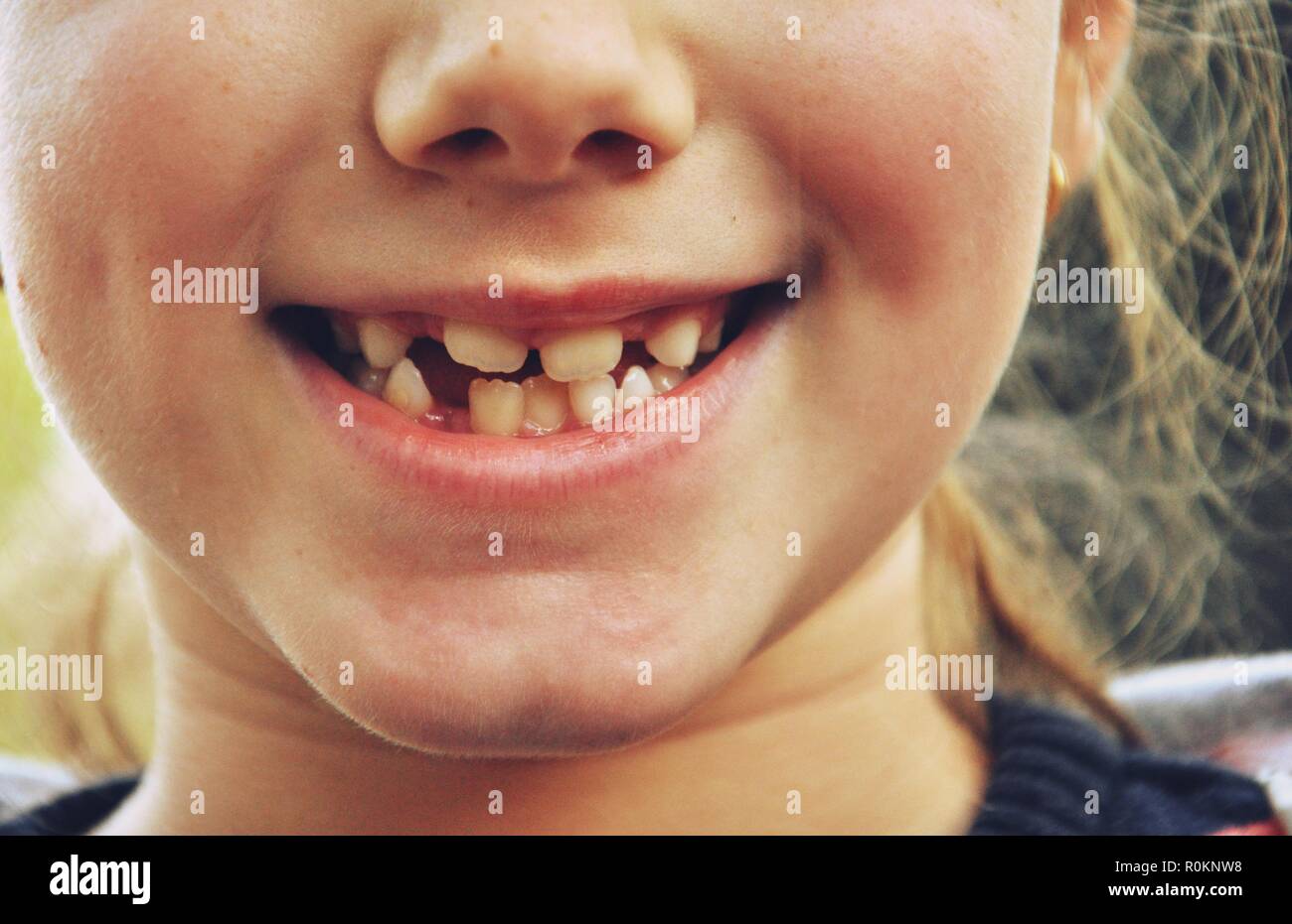 Nahaufnahme eines Mundes eines weißen Kaukasischen 9 Jahre alten Kind, Mädchen, mit steifen Zähne Stockfoto