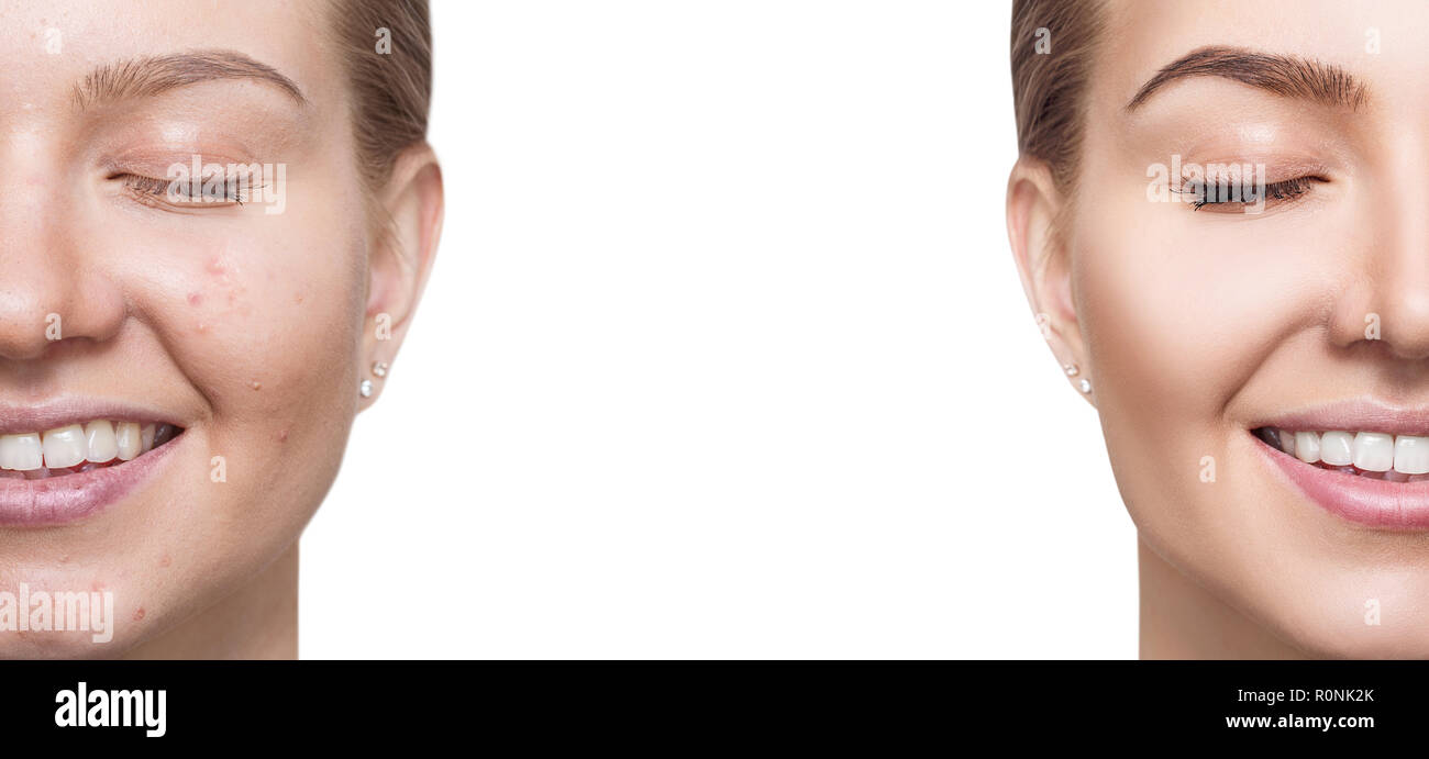 Frau mit Akne vor und nach Behandlung und Make-up. Stockfoto