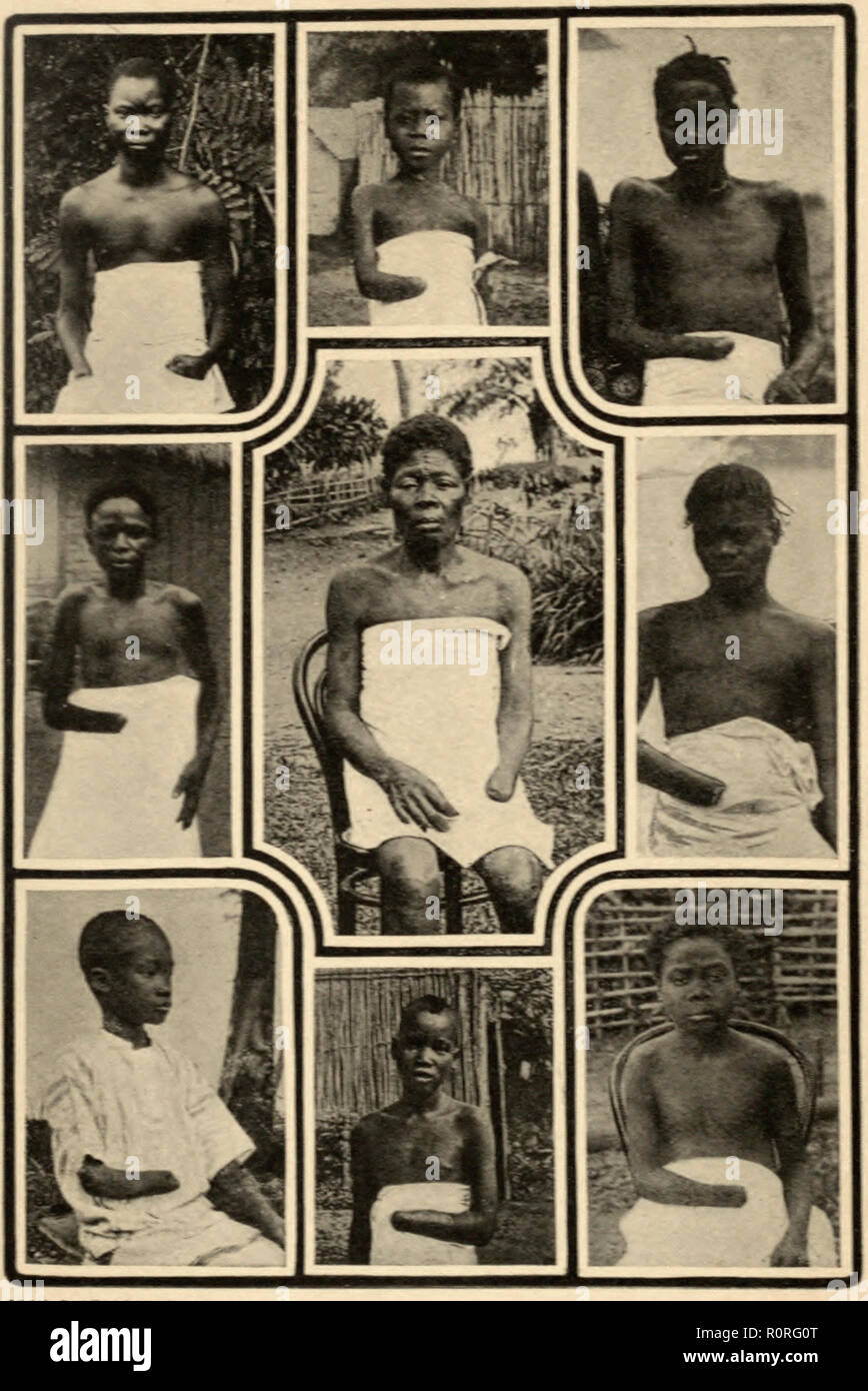 Der kongolesischen Kinder und Erwachsene Verstümmelt (C. 1900-1905) in der belgischen Kolonialzeit Freistaat Kongo (heute Demokratische Republik Kongo) Stockfoto