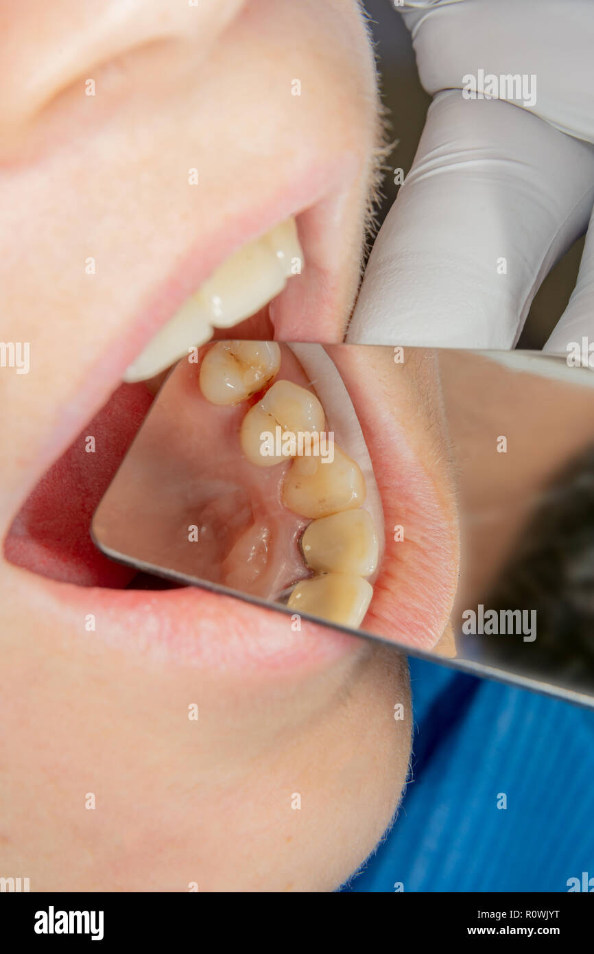 Zahnärztliche Behandlung in der Zahnarztpraxis. Faule kariösen Zahn Nahaufnahme Makro. Behandlung der endodontischen Kanäle Stockfoto