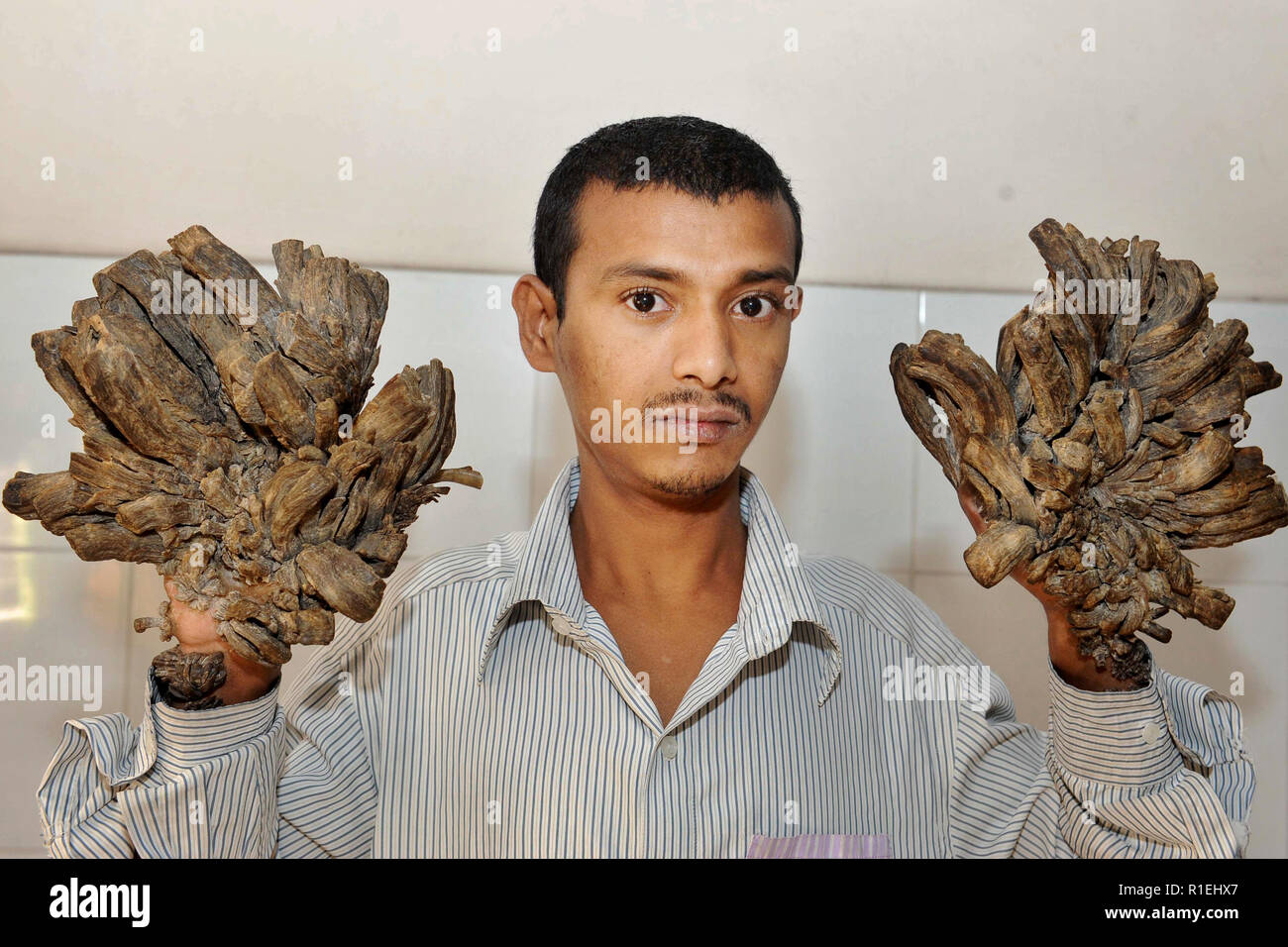 Dhaka, Bangladesch - Februar 02 2016: Bangladesch mann Abul Bajadar, 25, sitzt auf seinem schlechten an einem Krankenhaus in Dhaka, Bangladesh. Bajadar leidet seit Stockfoto