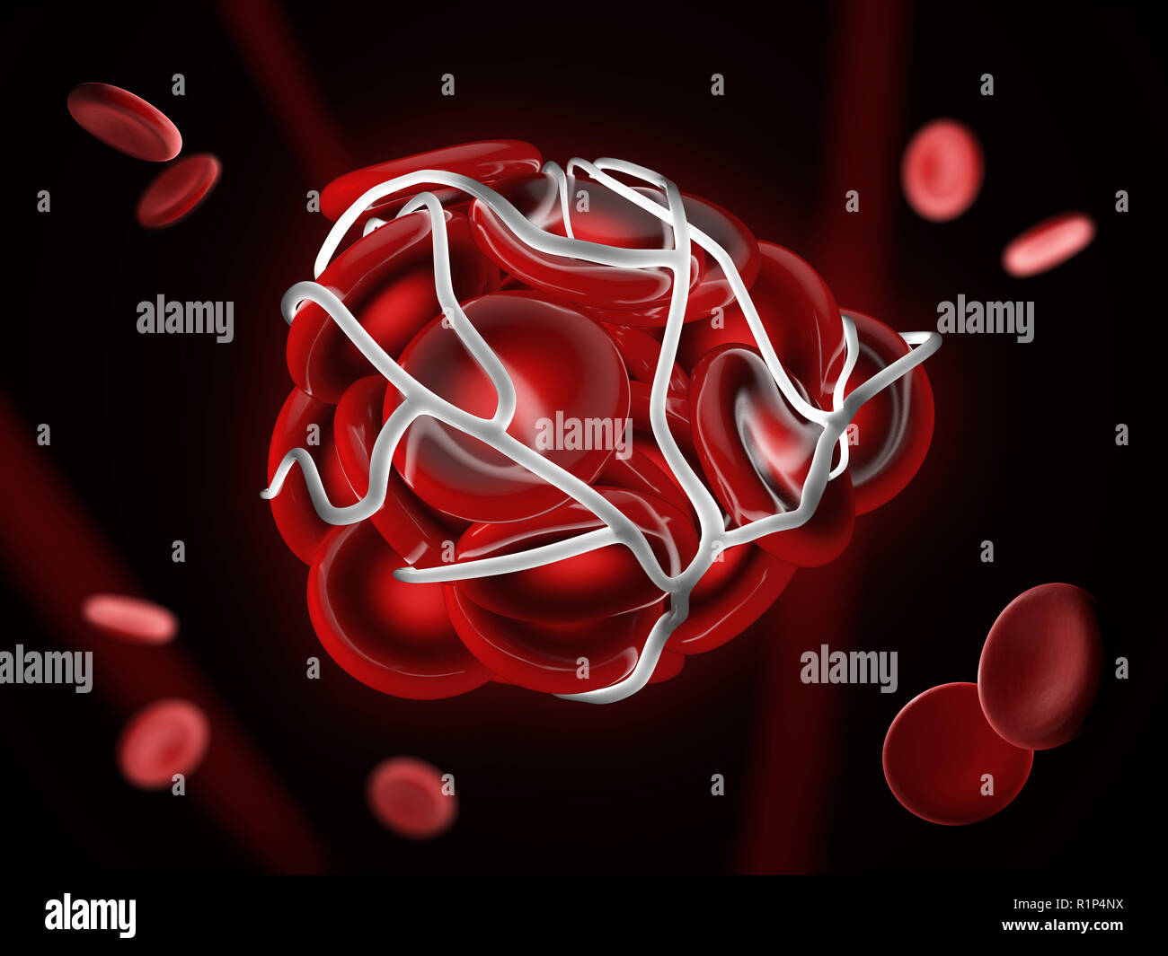 3D-Darstellung der Abbildung eines Blutgerinnsels, Thrombose oder Lungenembolie mit Geronnenem rote Blutkörperchen. Stockfoto