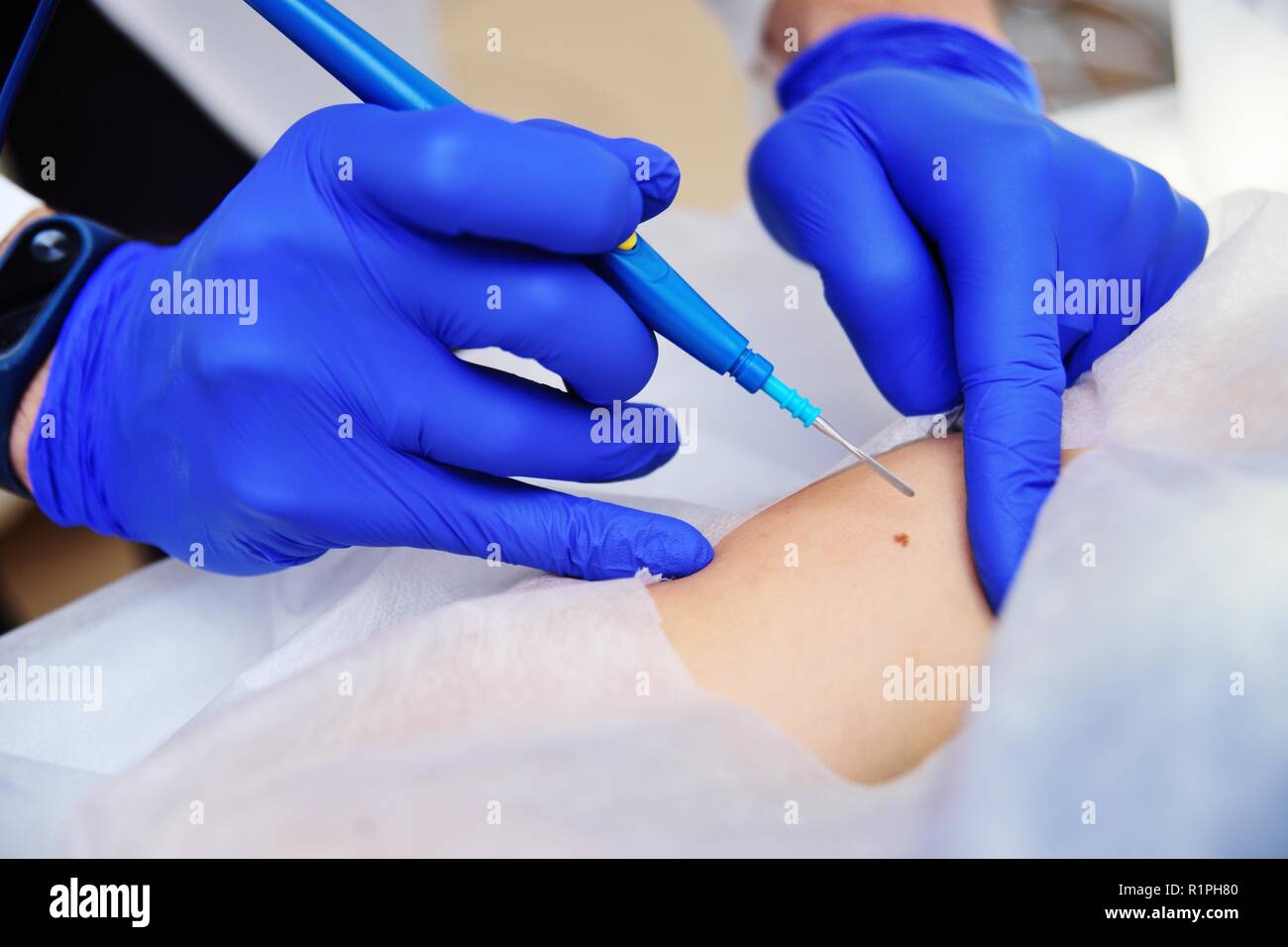 Der Chirurg Kosmetikerin entfernt Frau Muttermal des Patienten oder Muttermal auf der Hand mit einem Radio wave Messer. Hf Hochfrequenz- apparatu Stockfoto