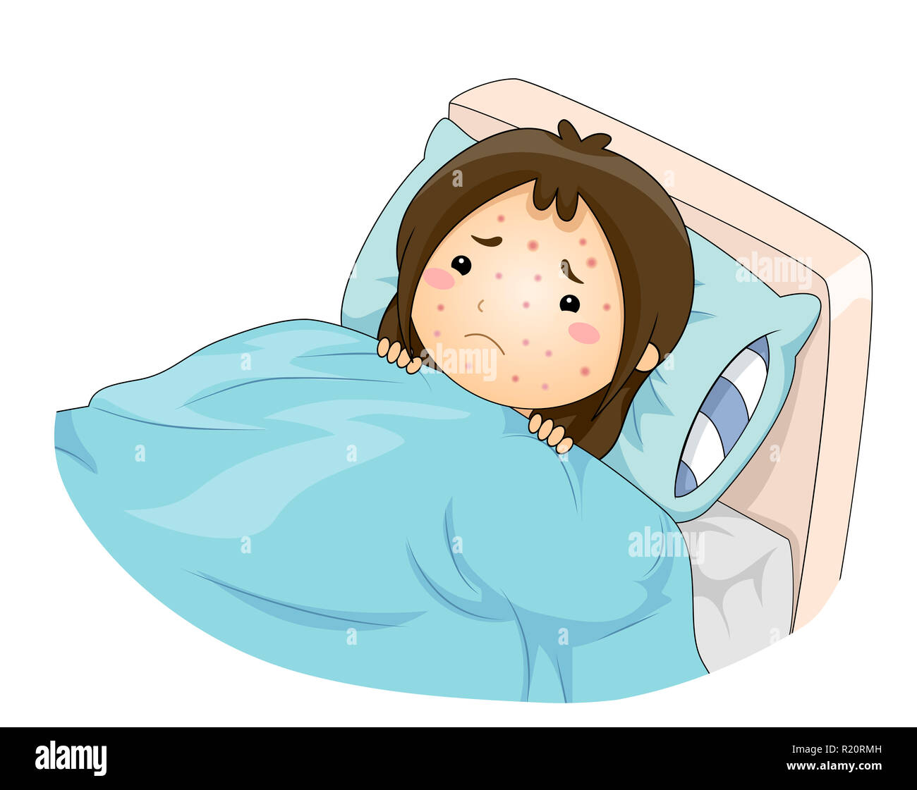 Abbildung: Ein trauriges Kind Mädchen im Bett mit Windpocken Stockfoto