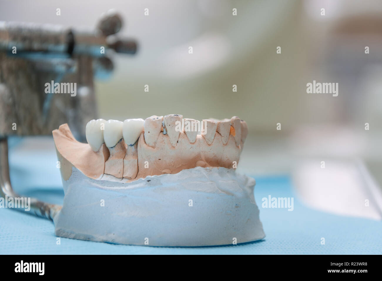Gips Stomatologie der menschliche Kiefer. Keramik - Metall Krone auf gipsmodell auf unscharfen Hintergrund der zahnmedizinischen Büro. Stockfoto