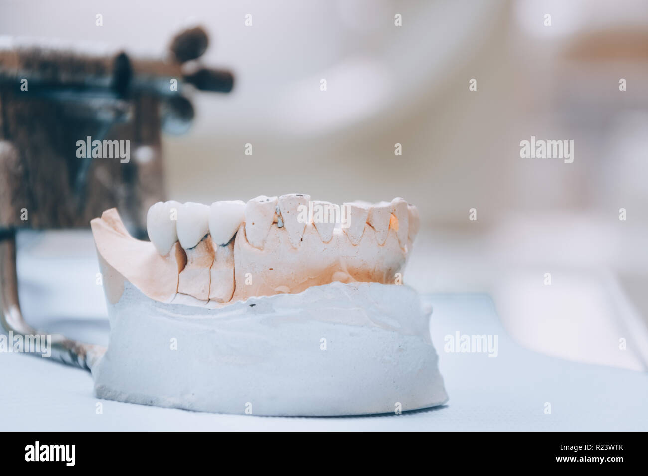 Gips Stomatologie der menschliche Kiefer. Keramik - Metall Krone auf gipsmodell auf unscharfen Hintergrund der zahnmedizinischen Büro. Weißer Ton Stockfoto