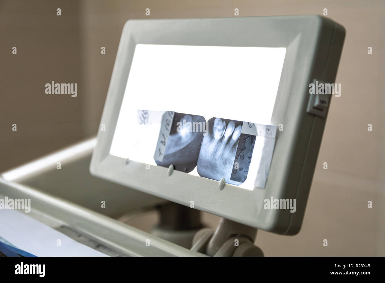 X-ray Bild auf LED-Hintergrund. Zahnpflege, Zahnpflege, checkup und Therapie Konzept. Stockfoto