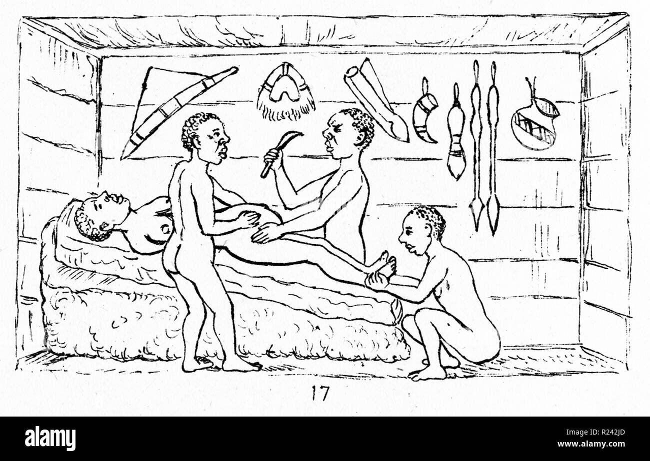 Erfolgreiche Kaiserschnitt durchgeführt von indigenen Heilern in Kahura, Uganda. Wie R. W. Felkin 1879 aus seinem Artikel veröffentlicht "Notes on Labour in Zentralafrika" in Edinburgh Medical Journal, Band 20, April 1884 Stockfoto