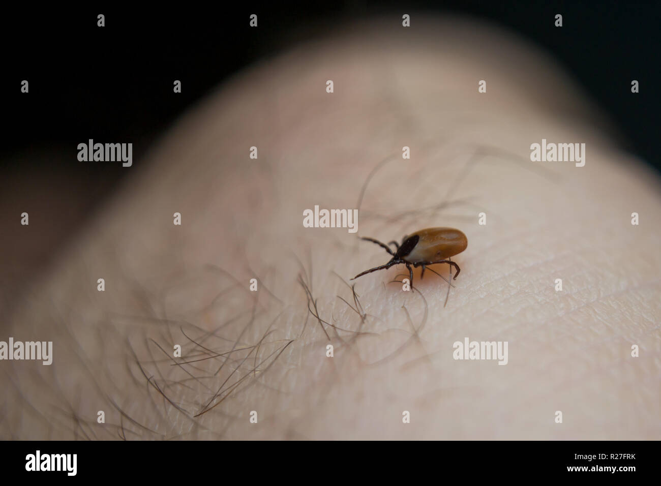 Nach tick auf der menschlichen Haut Stockfoto