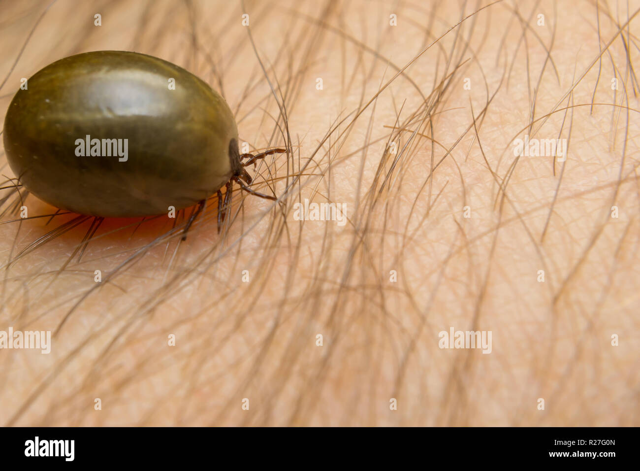 Nach tick auf der menschlichen Haut Stockfoto