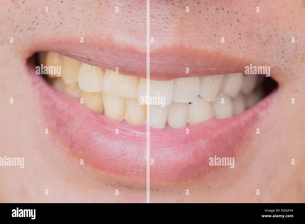 Bleichen von Zähnen vergleichen, bevor nach den zahnmedizinischen Behandlung. Stockfoto