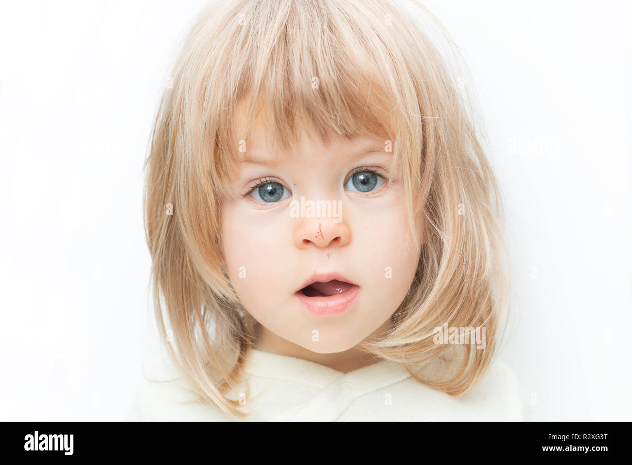 Close up Portrait blonde Haare Baby Mädchen mit einem Kratzer auf der Nase auf dem weißen Hintergrund. Überrascht weiblichen Kleinkind, hält Öffnung geöffnet. Kind Sicherheitskonzept, Verletzungen durch Herabfallen. Stockfoto