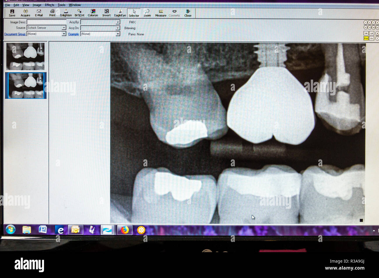 Miami Beach Florida, Zahnarztpraxis, Röntgenstrahlen Röntgenstrahlen, Zahnzähne, Implantat Wurzelkanal Schraube Krone Füllung, FL181030027 Stockfoto