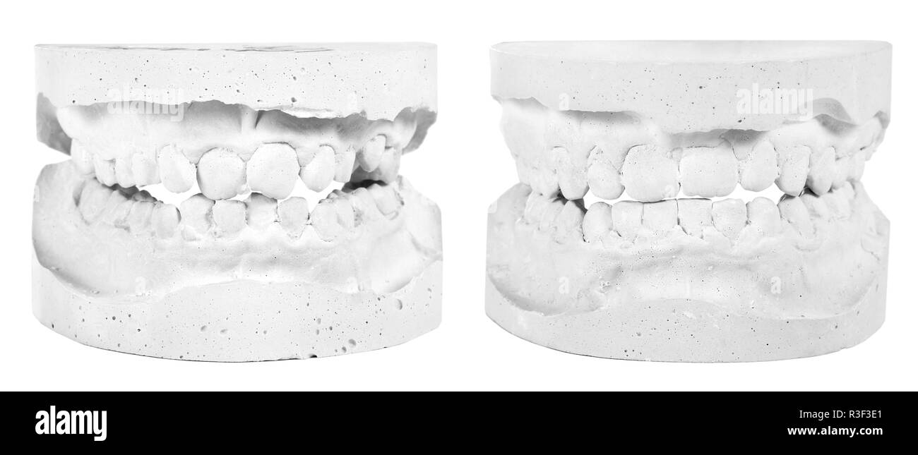 Gipsabgüsse vor und nach der Behandlung Stockfoto
